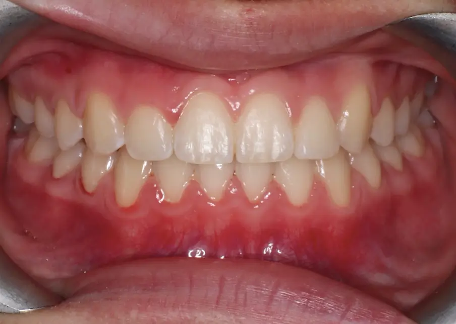 After Intraoral Centre Tooth Photo