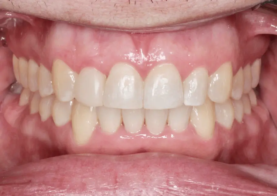 After Intraoral Centre Tooth Photo