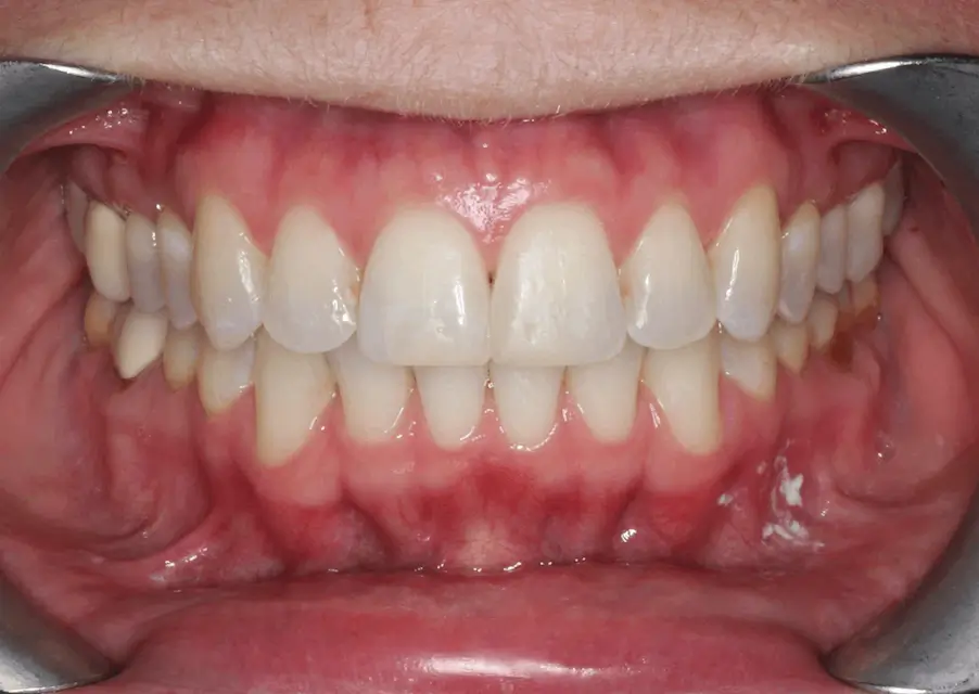After Intraoral Centre Tooth Photo