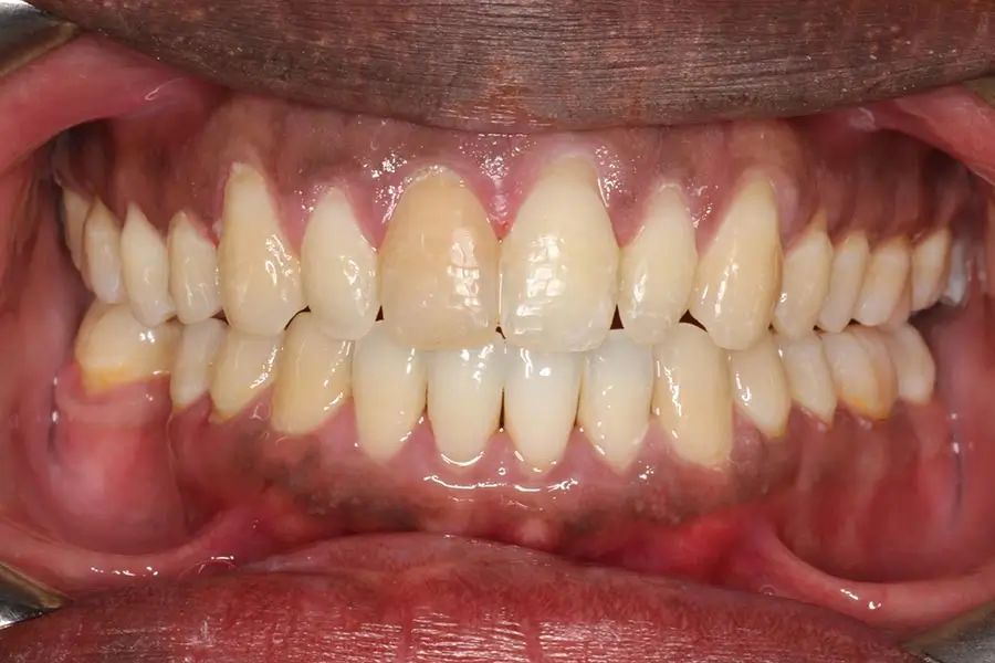 After Intraoral Centre Tooth Photo