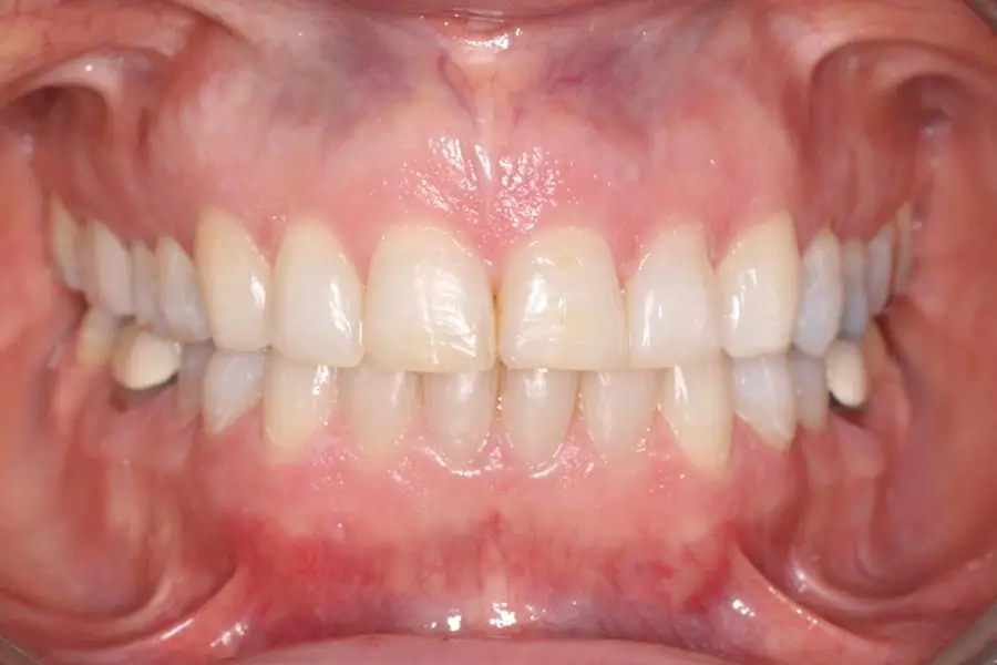 After Intraoral Centre Tooth Photo