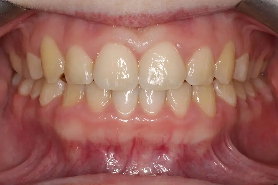 After Intraoral Centre Tooth Photo