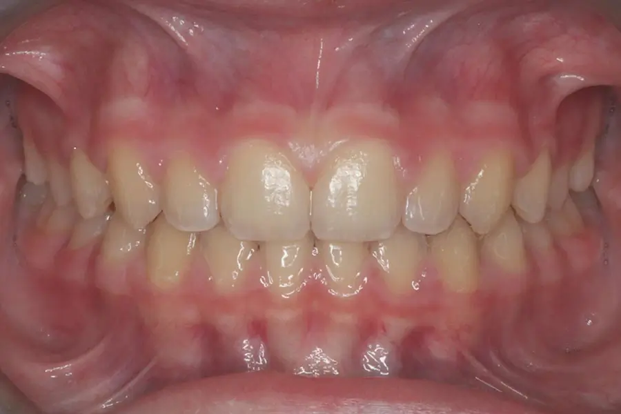 After Intraoral Centre Tooth Photo
