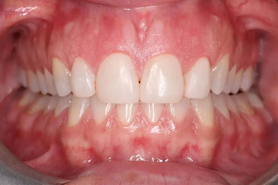 After Intraoral Centre Tooth Photo