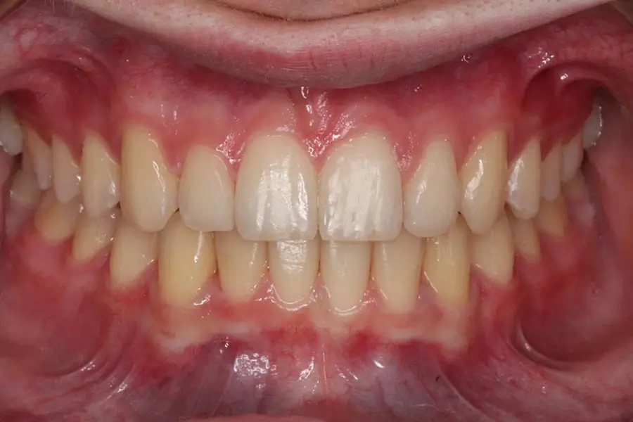 After Intraoral Centre Tooth Photo
