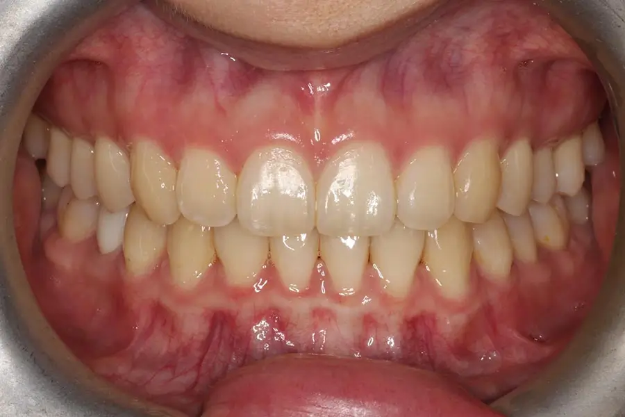 After Intraoral Centre Tooth Photo