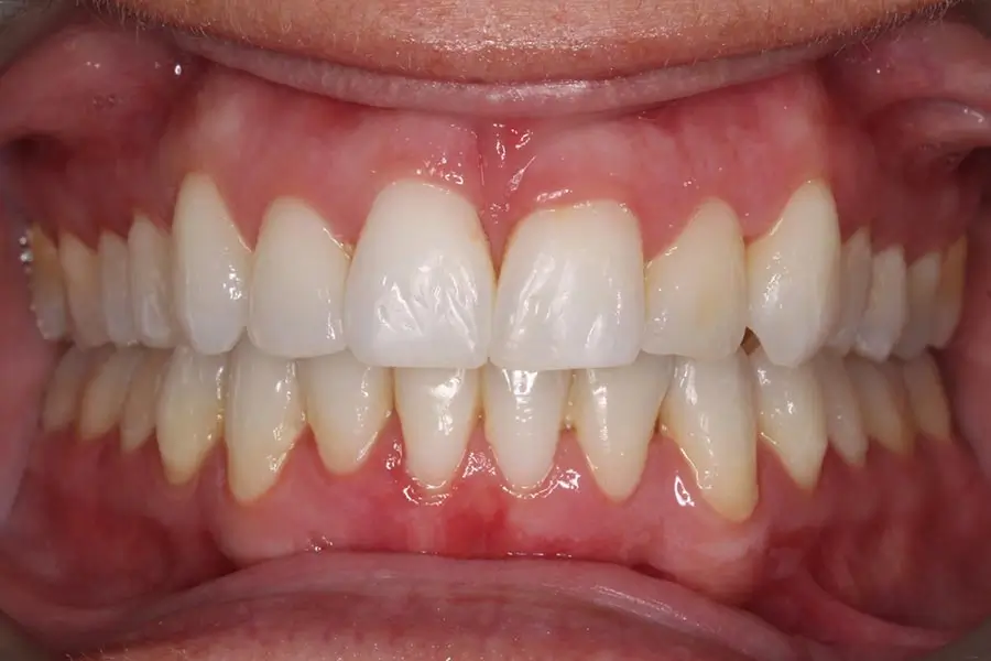 After Intraoral Centre Tooth Photo