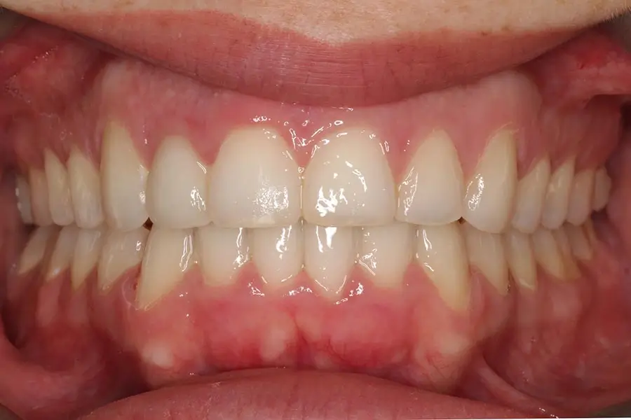 After Intraoral Centre Tooth Photo