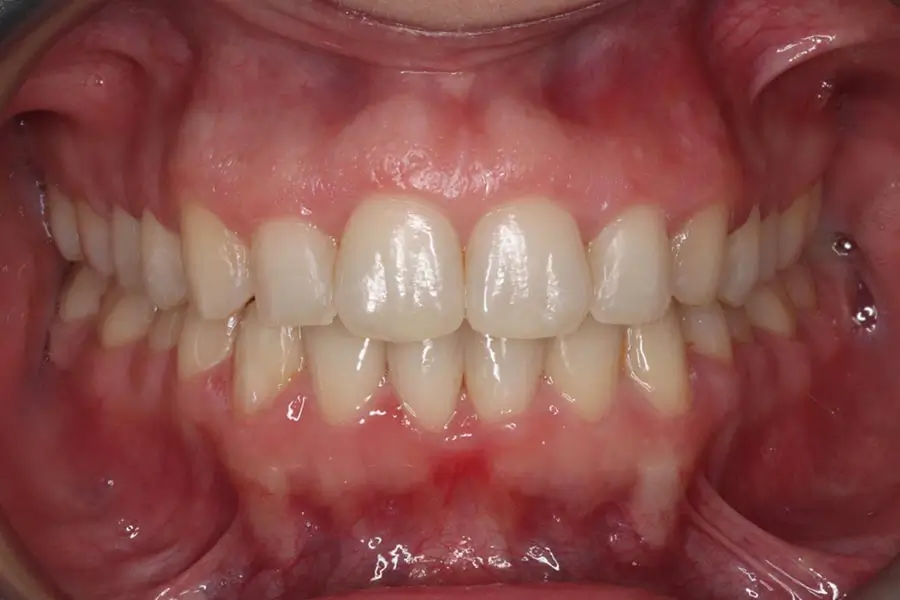 After Intraoral Centre Tooth Photo