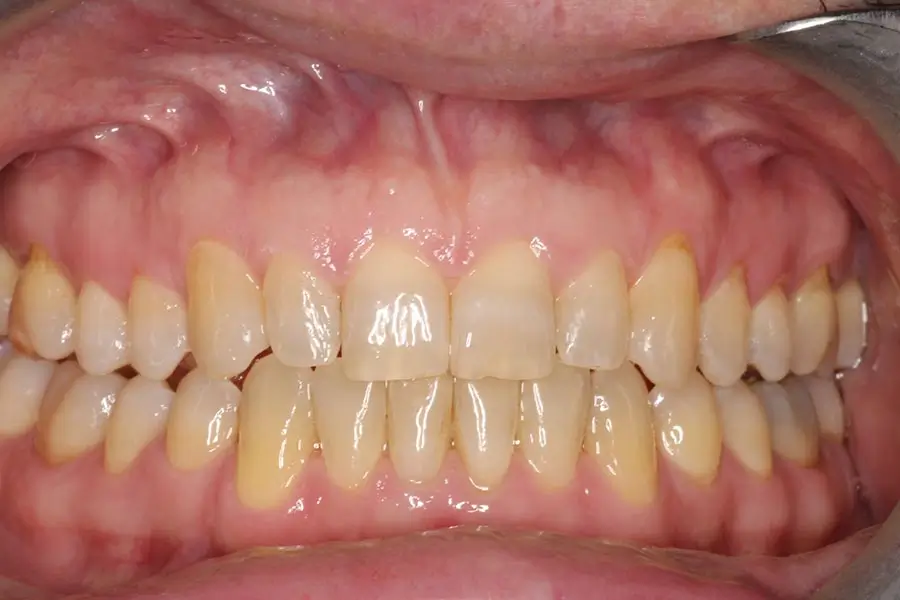 After Intraoral Centre Tooth Photo