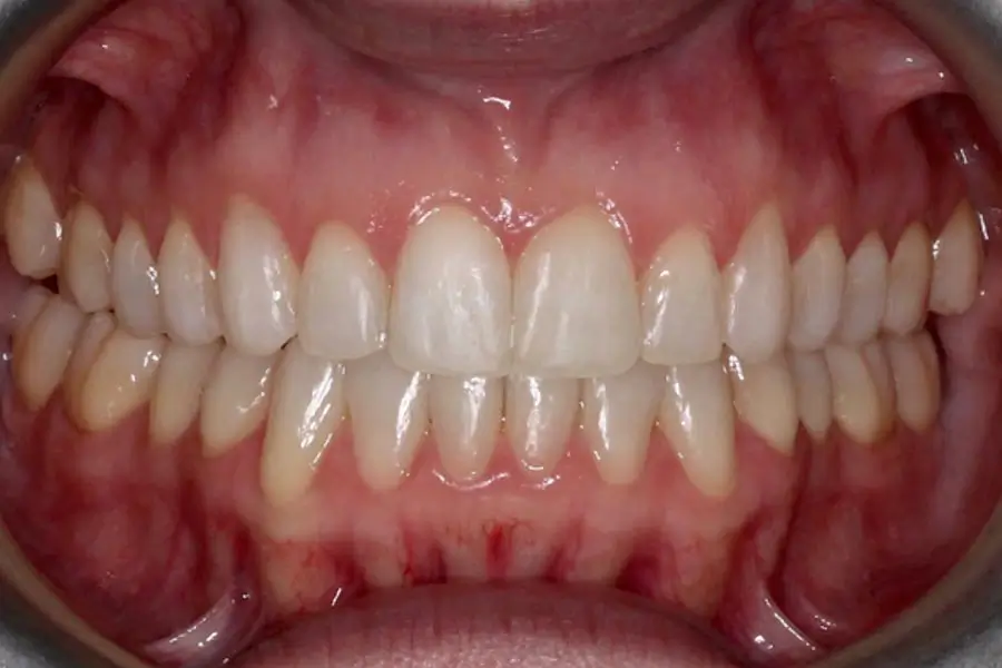 After Intraoral Centre Tooth Photo