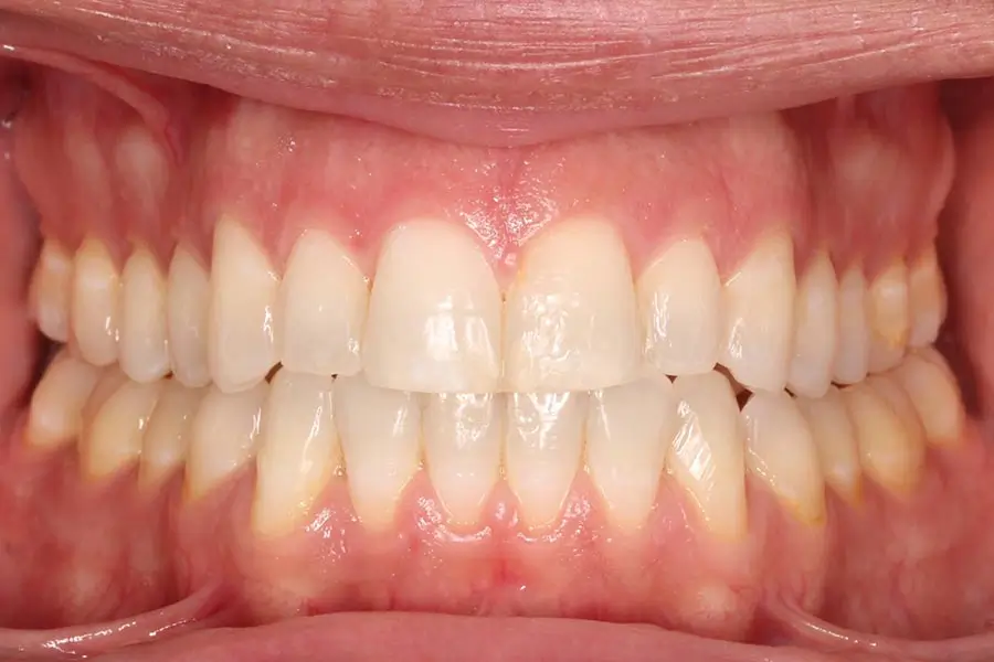 After Intraoral Centre Tooth Photo