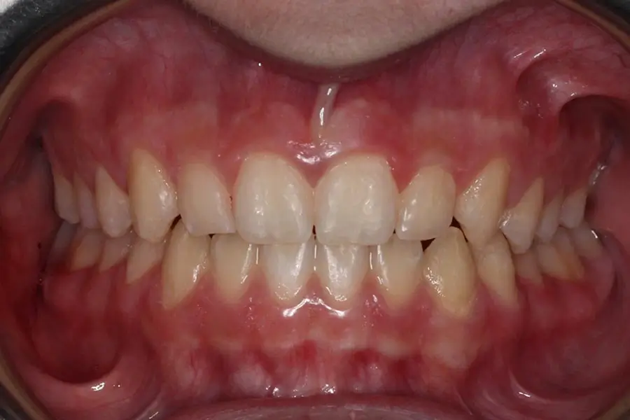 After Intraoral Centre Tooth Photo
