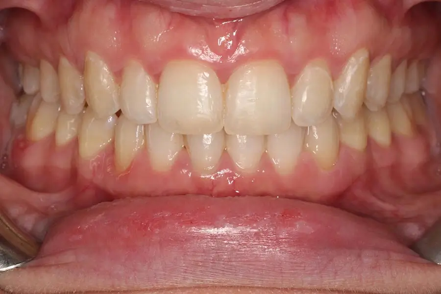 After Intraoral Centre Tooth Photo