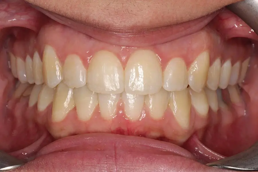 After Intraoral Centre Tooth Photo