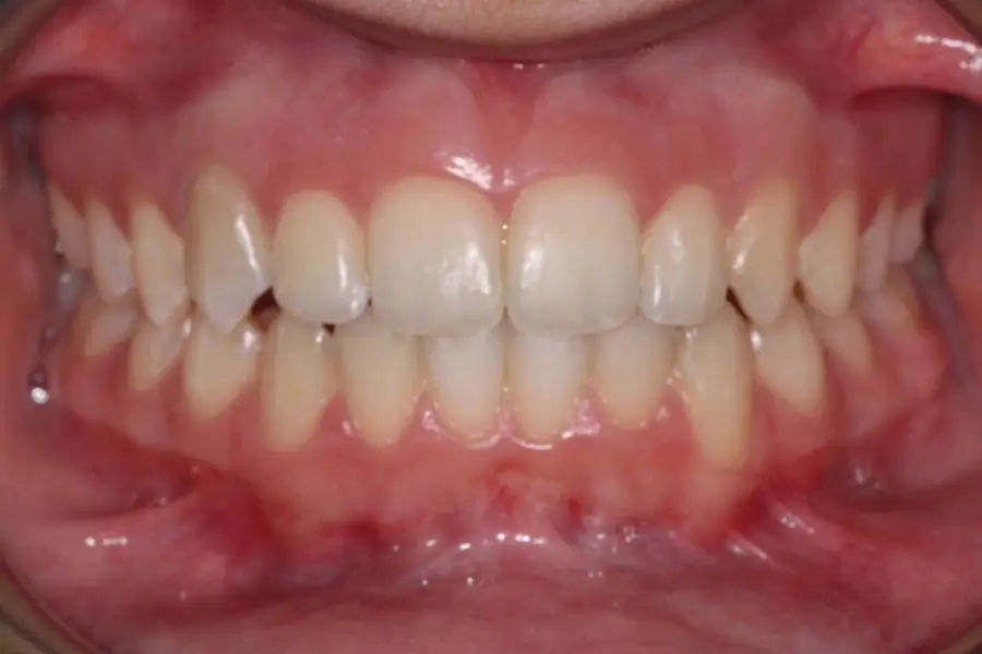 After Intraoral Centre Tooth Photo
