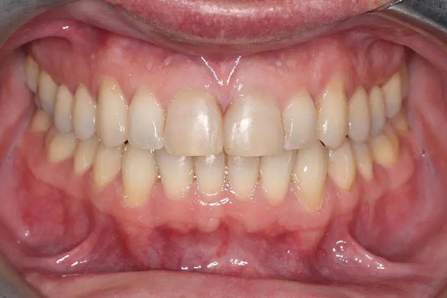 After Intraoral Centre Tooth Photo