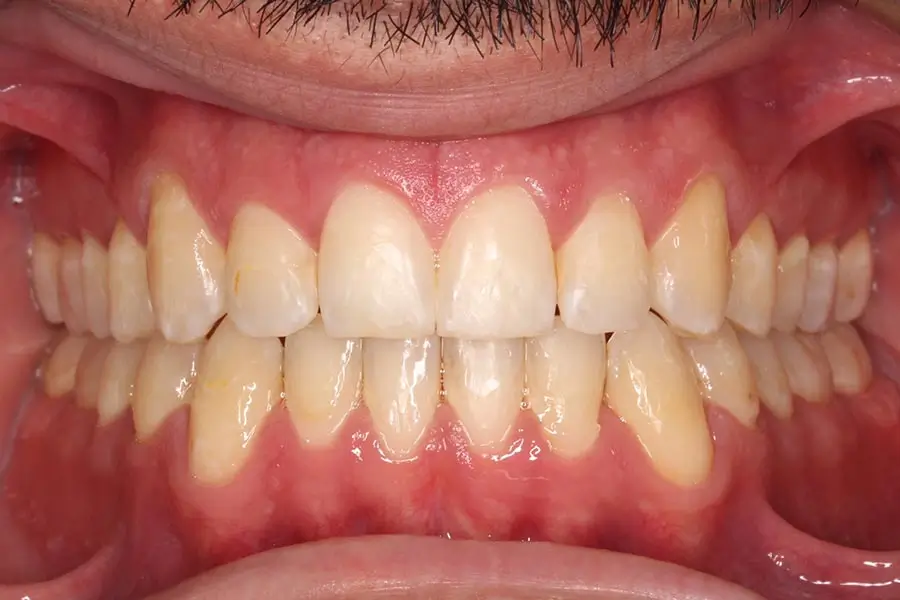 After Intraoral Centre Tooth Photo
