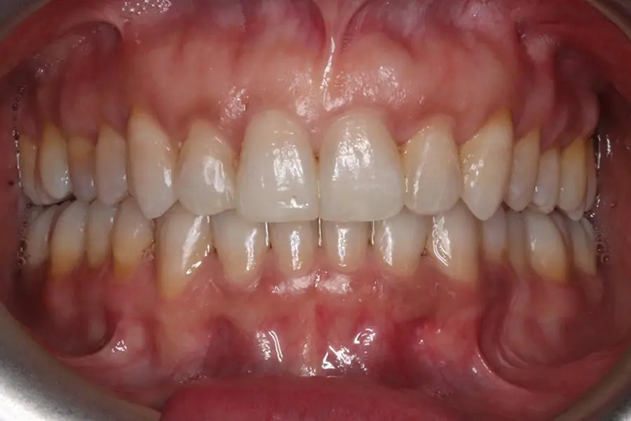 After Intraoral Centre Tooth Photo