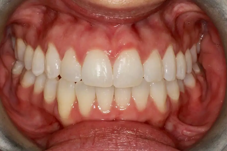 After Intraoral Centre Tooth Photo