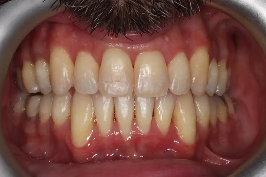 After Intraoral Centre Tooth Photo