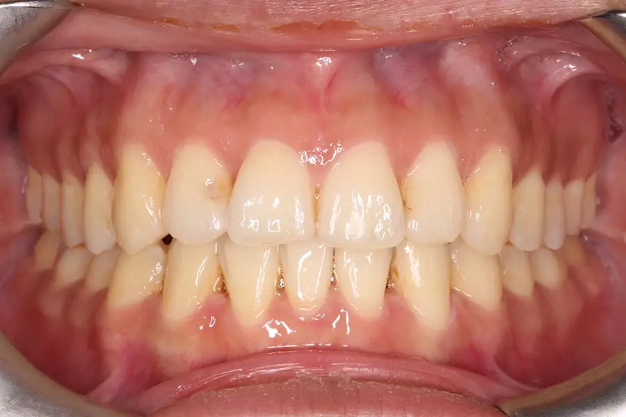 After Intraoral Centre Tooth Photo