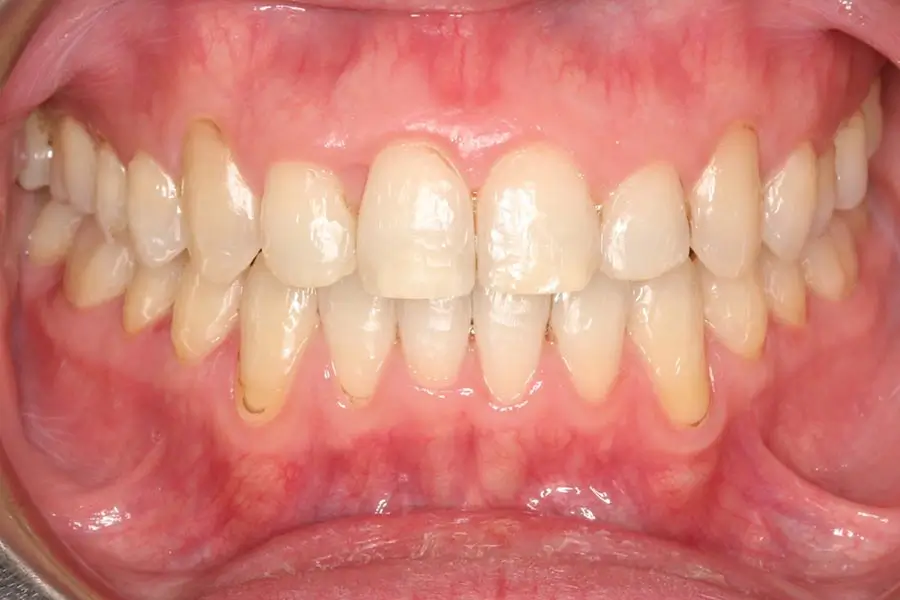 After Intraoral Centre Tooth Photo