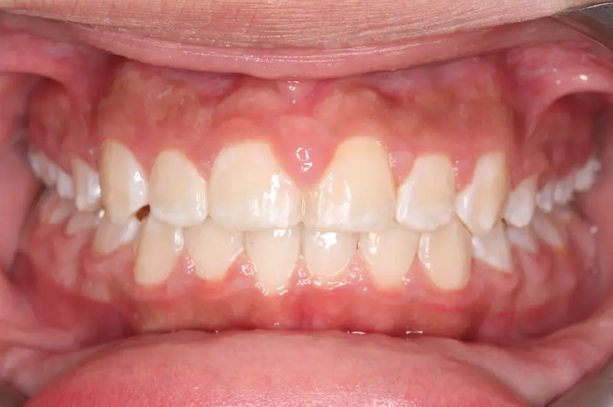 After Intraoral Centre Tooth Photo