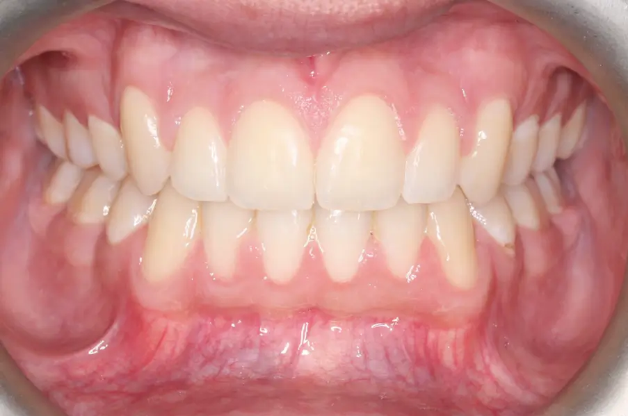 After Intraoral Centre Tooth Photo