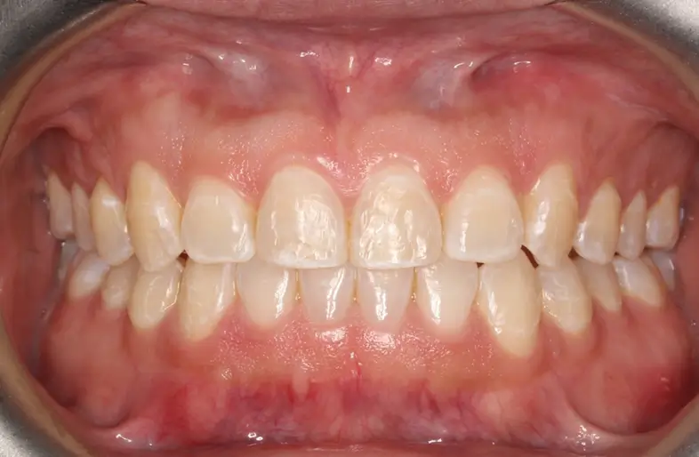 After Intraoral Centre Tooth Photo
