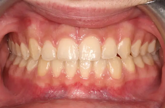 After Intraoral Centre Tooth Photo