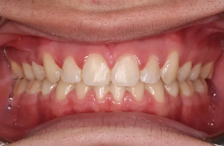 After Intraoral Centre Tooth Photo