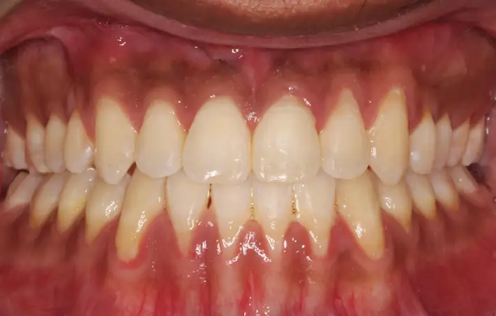 After Intraoral Centre Tooth Photo