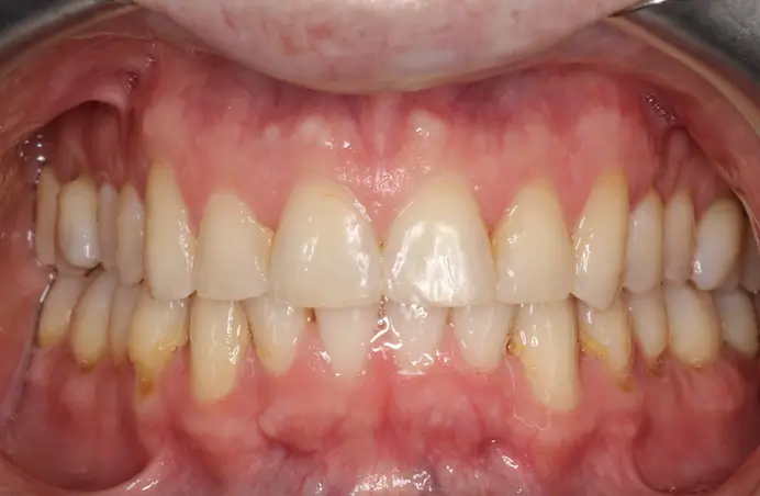After Intraoral Centre Tooth Photo
