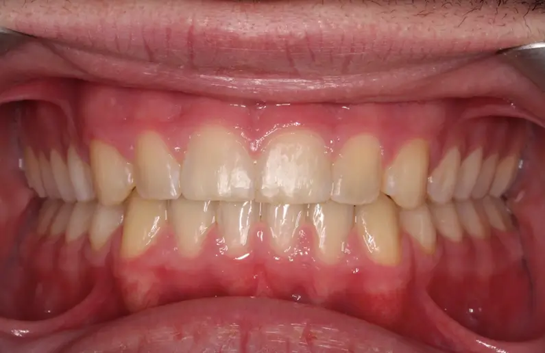 After Intraoral Centre Tooth Photo