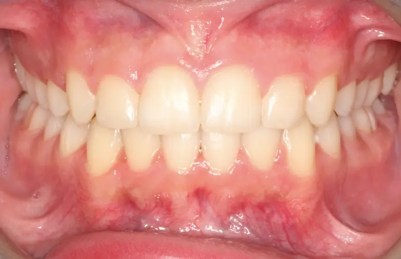 After Intraoral Centre Tooth Photo