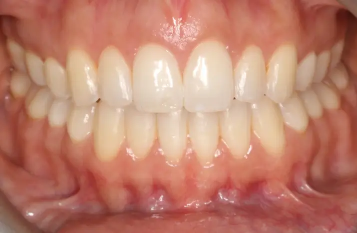 After Intraoral Centre Tooth Photo