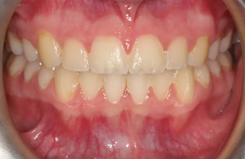 After Intraoral Centre Tooth Photo