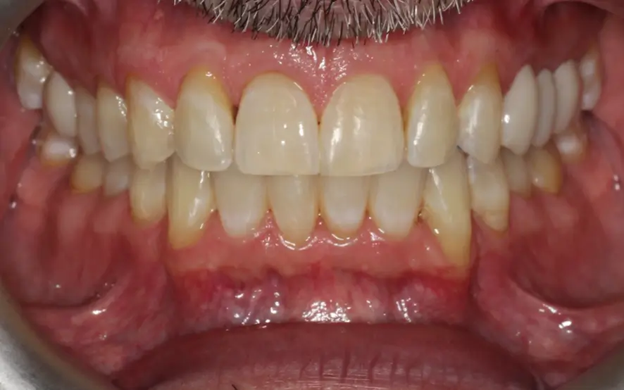After Intraoral Centre Tooth Photo