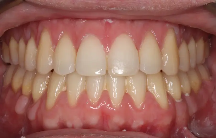 After Intraoral Centre Tooth Photo