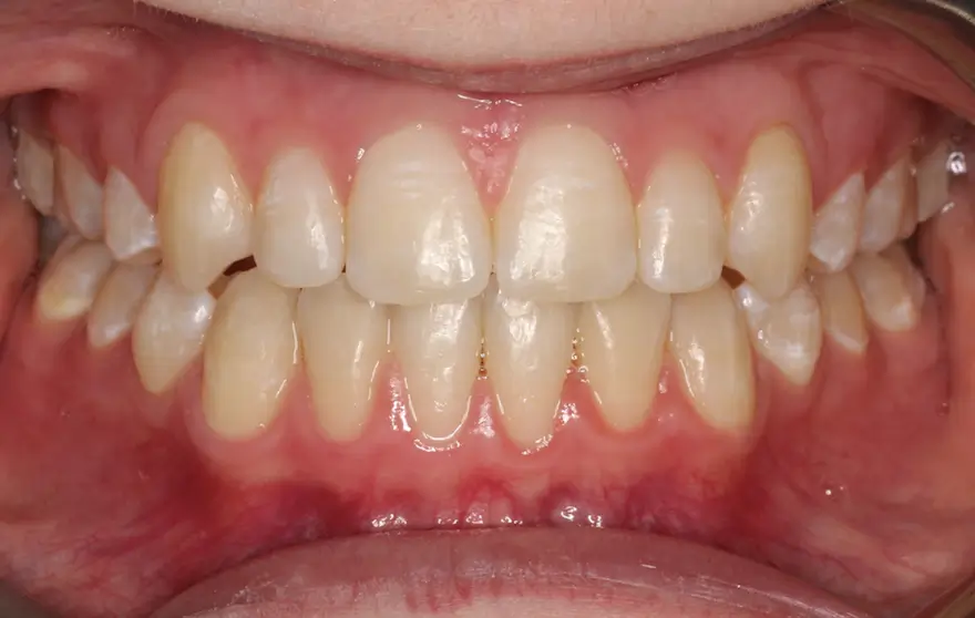 After Intraoral Centre Tooth Photo