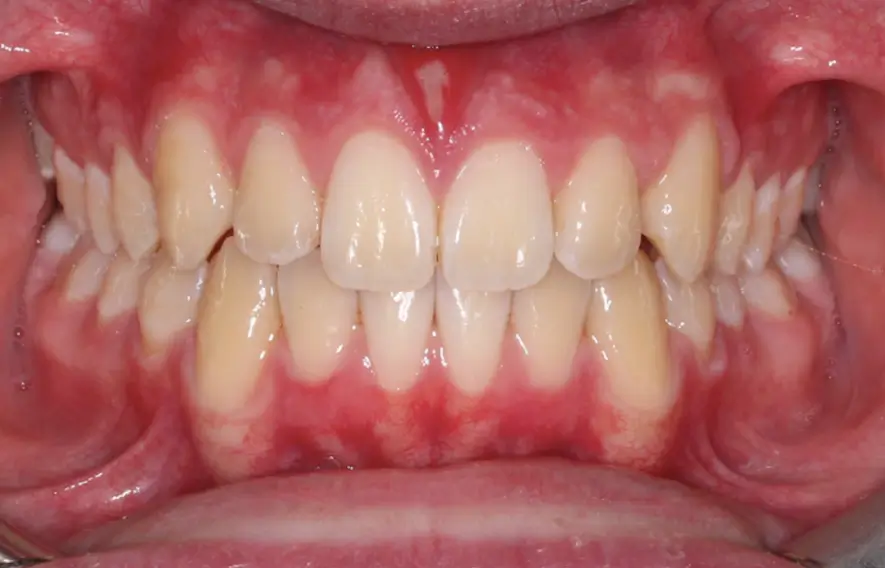 After Intraoral Centre Tooth Photo