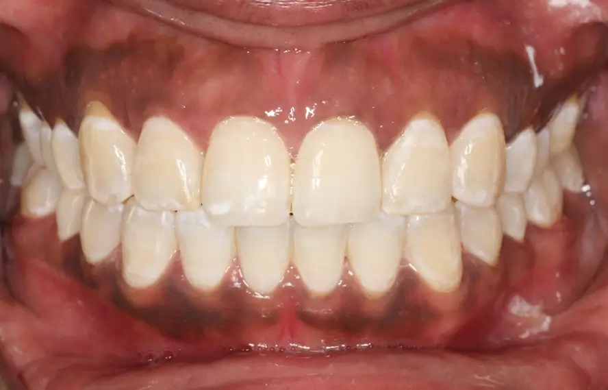After Intraoral Centre Tooth Photo