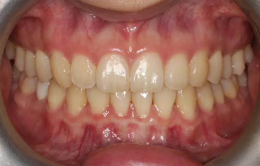 After Intraoral Centre Tooth Photo