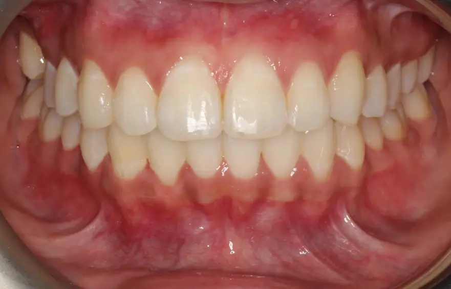 After Intraoral Centre Tooth Photo
