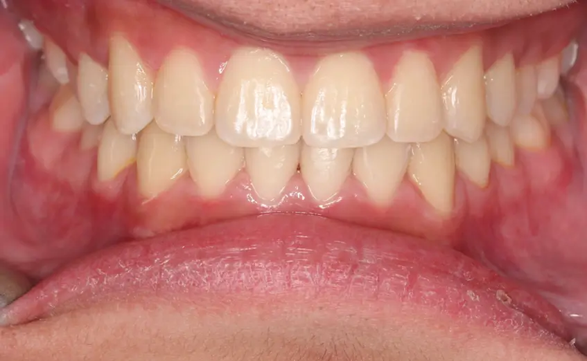 After Intraoral Centre Tooth Photo