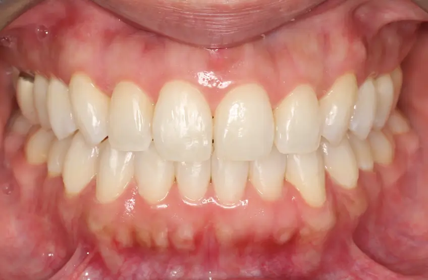 After Intraoral Centre Tooth Photo