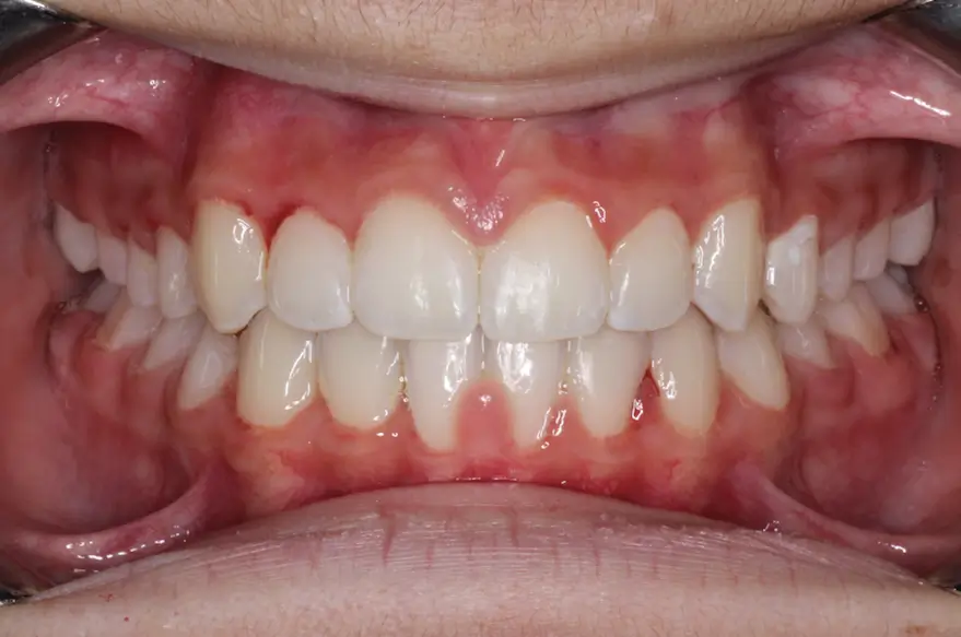 After Intraoral Centre Tooth Photo