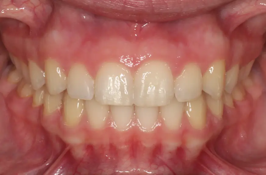 After Intraoral Centre Tooth Photo