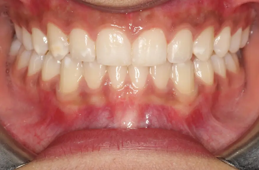 After Intraoral Centre Tooth Photo